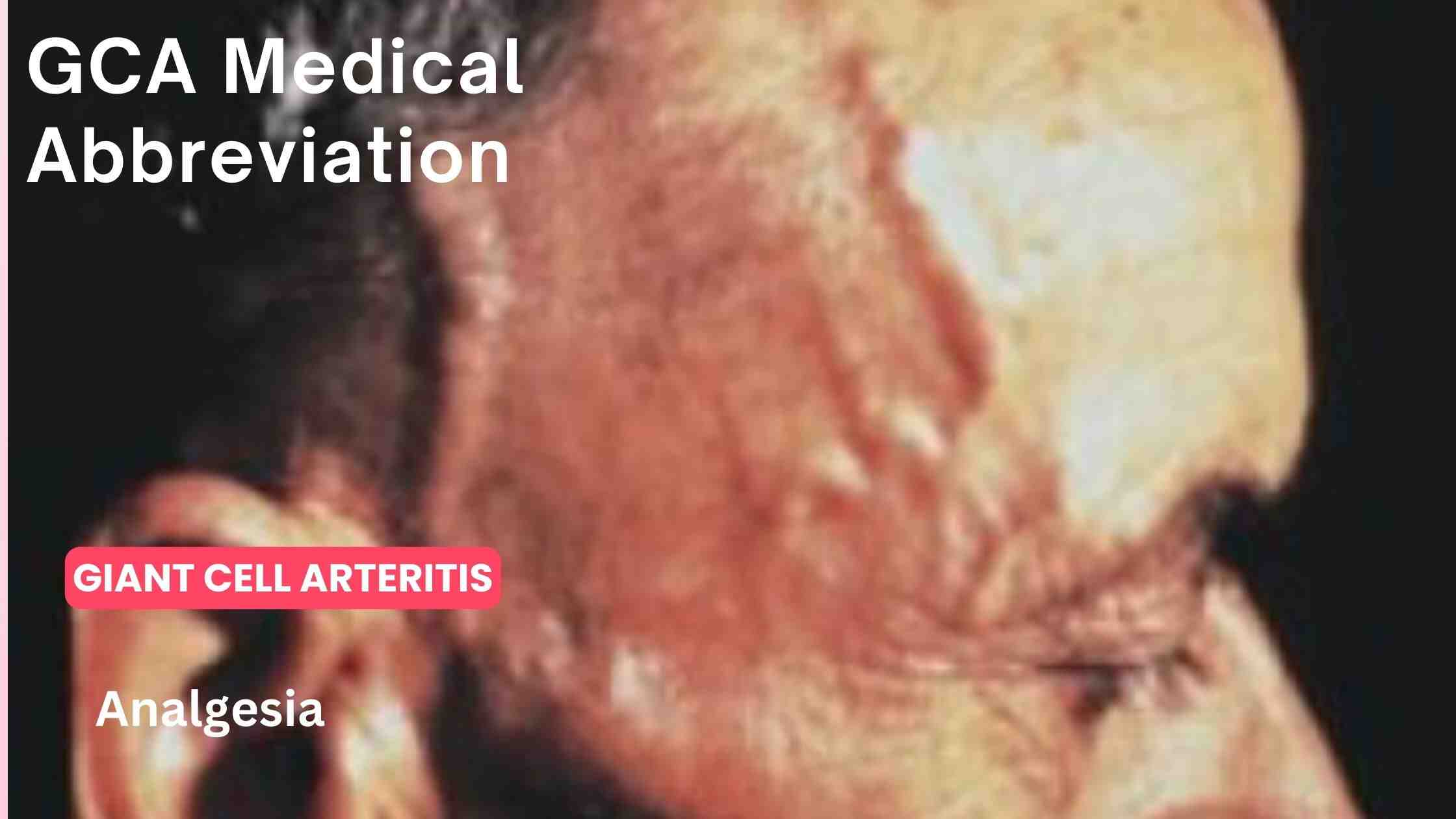GCA Medical Abbreviation: What It Means and Why It Matters - Analgesia