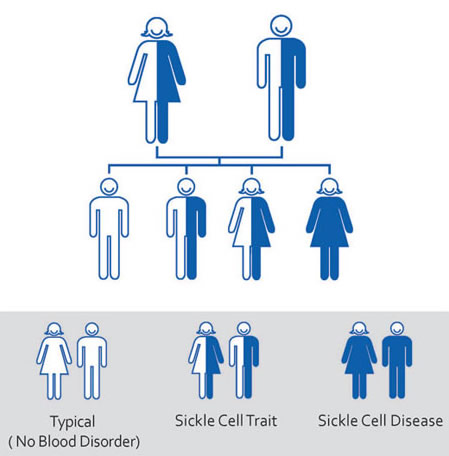 Causes of sickle cell disease