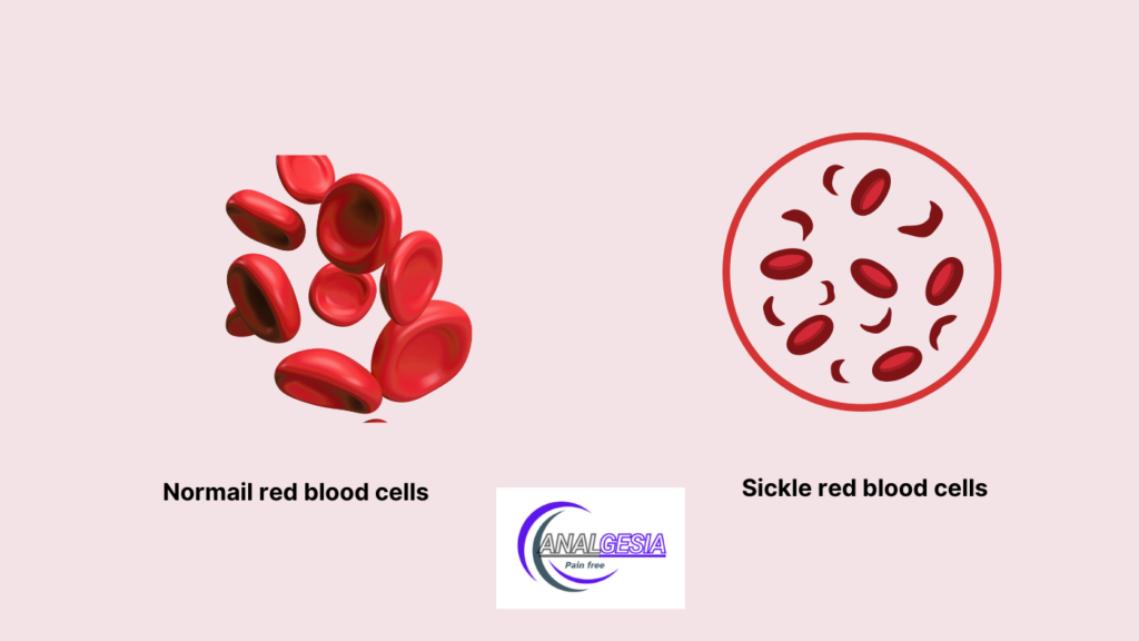 sickle red blood cells and a normal red blood cells